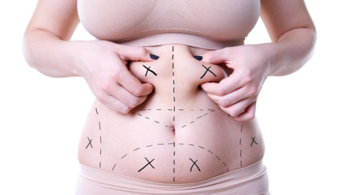 best liposuction in bangalore